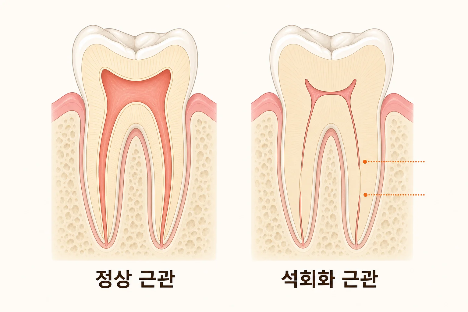석회화 근관, 신경치료가 더 어려운 이유 | 파주 서울이고운치과 내용을 설명하는 치과 진료 이미지