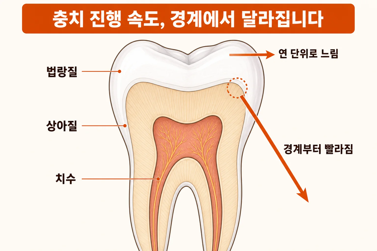 충치 방치하면 어떻게 되나 | 단계별 진행 속도와 치료가 커지는 시점 | 파주 서울이고운치과 내용을 설명하는 치과 진료 이미지