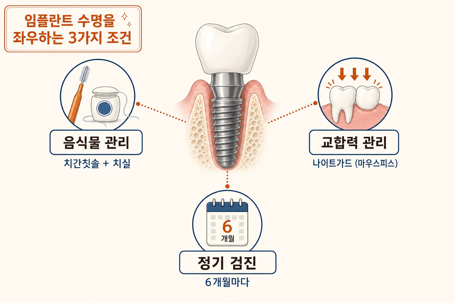 임플란트 수명, 10년 후에도 잘 쓰는 3가지 조건 내용을 설명하는 치과 진료 이미지