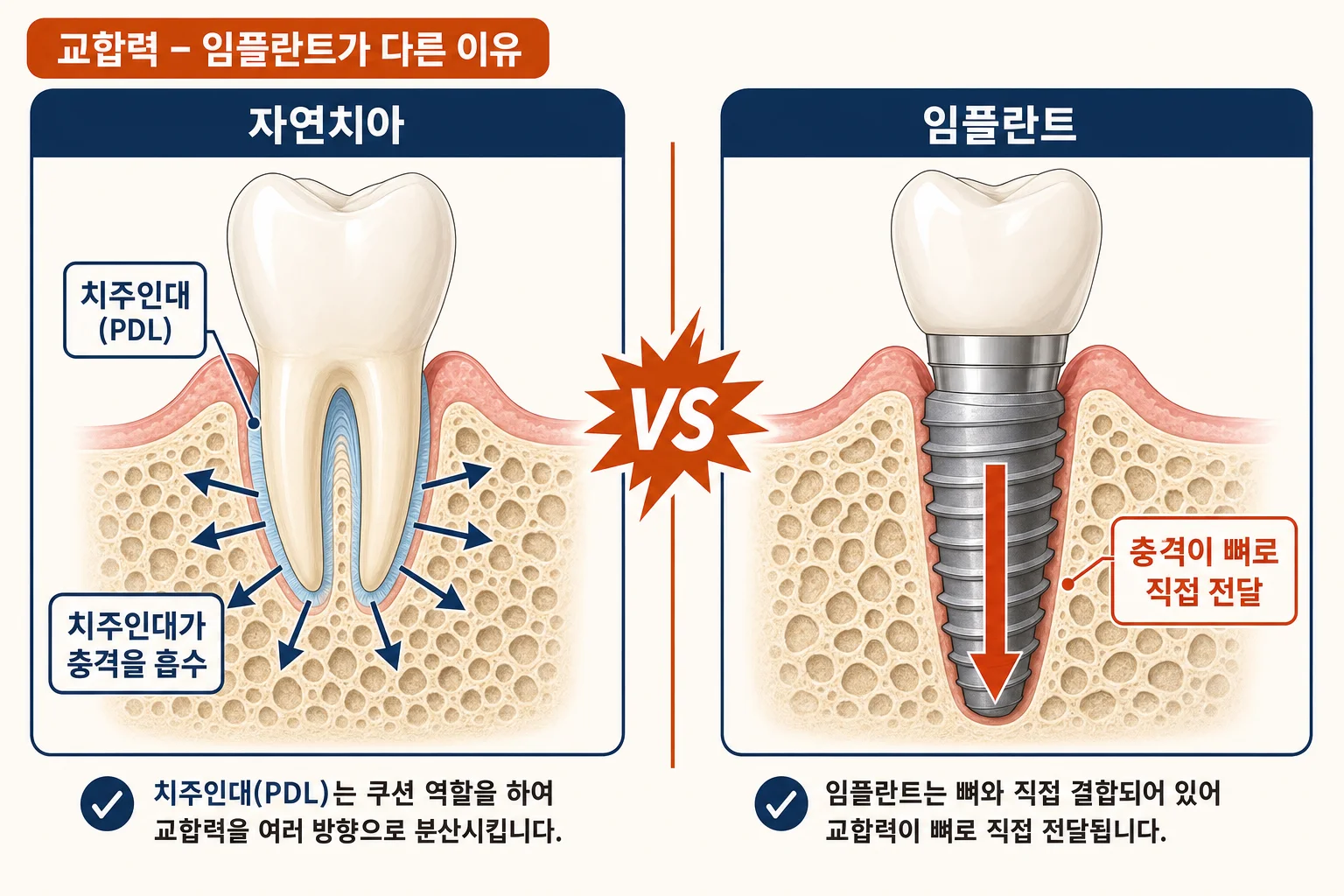 치주인대가 있는 자연치와 잇몸뼈에 직접 결합된 임플란트의 단면 비교