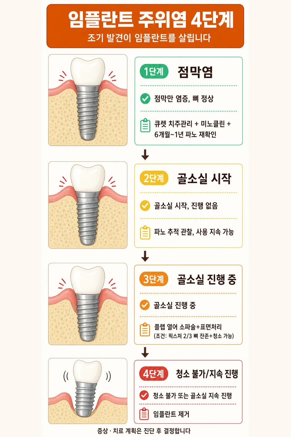 임플란트 주위 점막염부터 제거 판단까지 네 단계 대응 과정