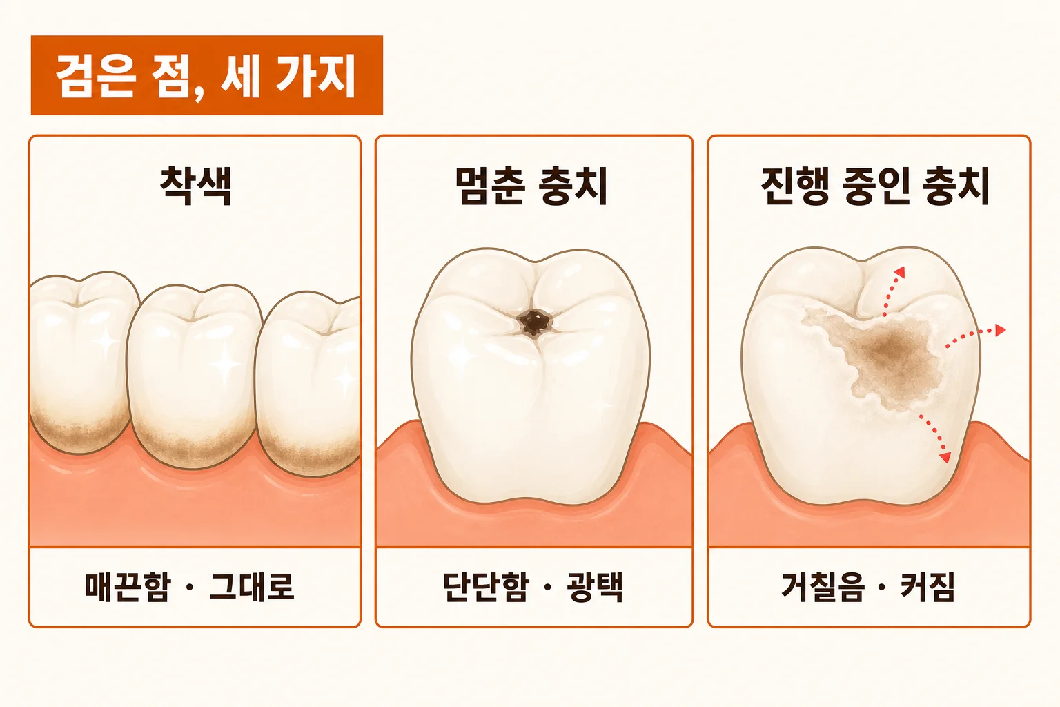 충치인지 아닌지 확인하는 법 | 검은 점·시림·구멍 판별 신호 | 파주 서울이고운치과 내용을 설명하는 치과 진료 이미지