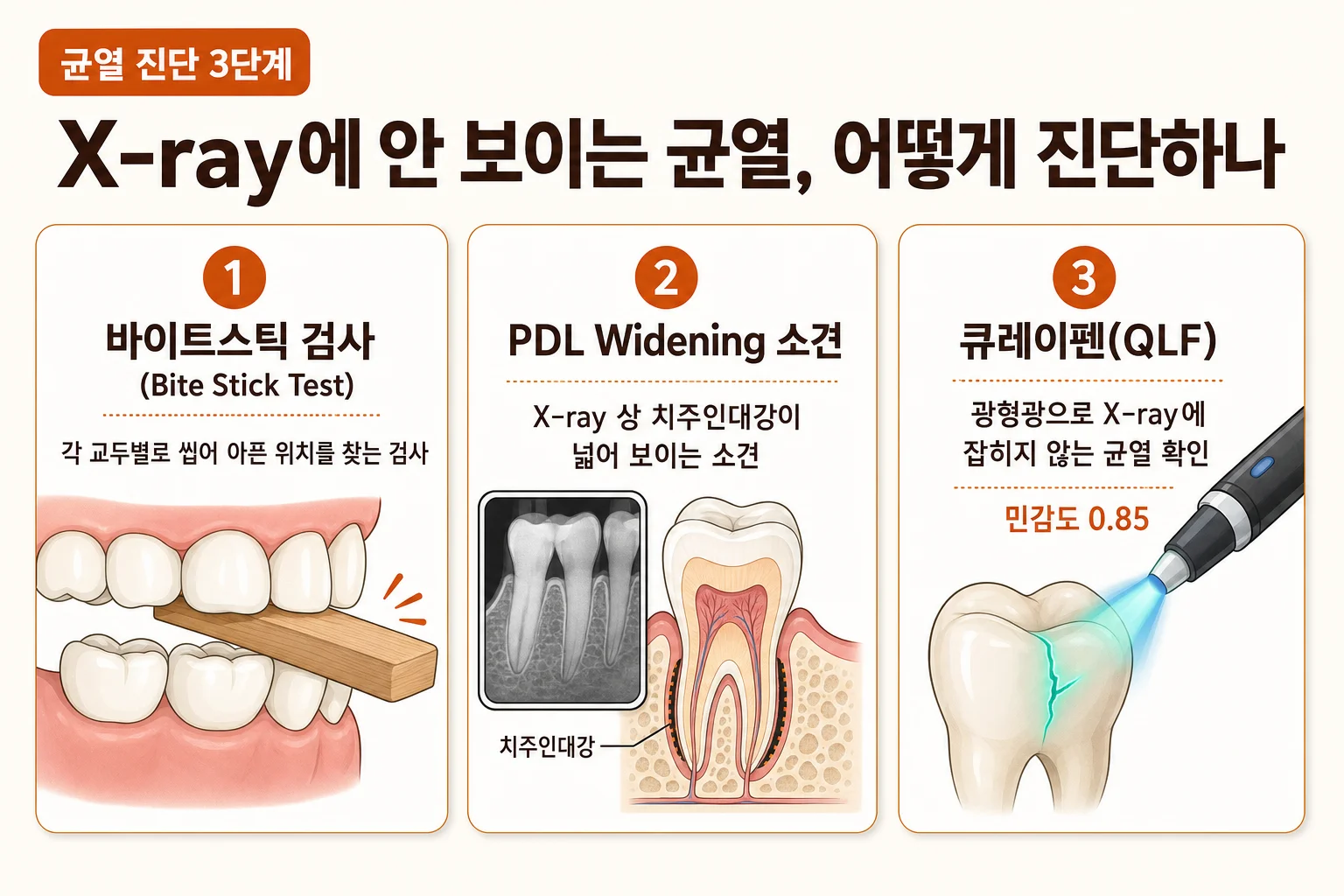 교두별로 통증 위치를 확인하는 치아 균열 바이트스틱 검사 도식