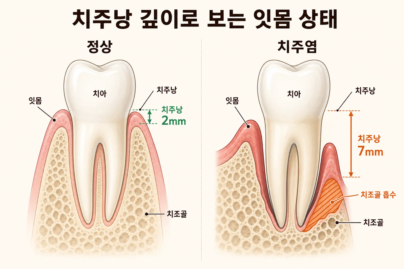 잇몸치료 한계 | 관리 안 하면 41% 재발·발치 갈림길 | 파주 서울이고운치과 내용을 설명하는 치과 진료 이미지