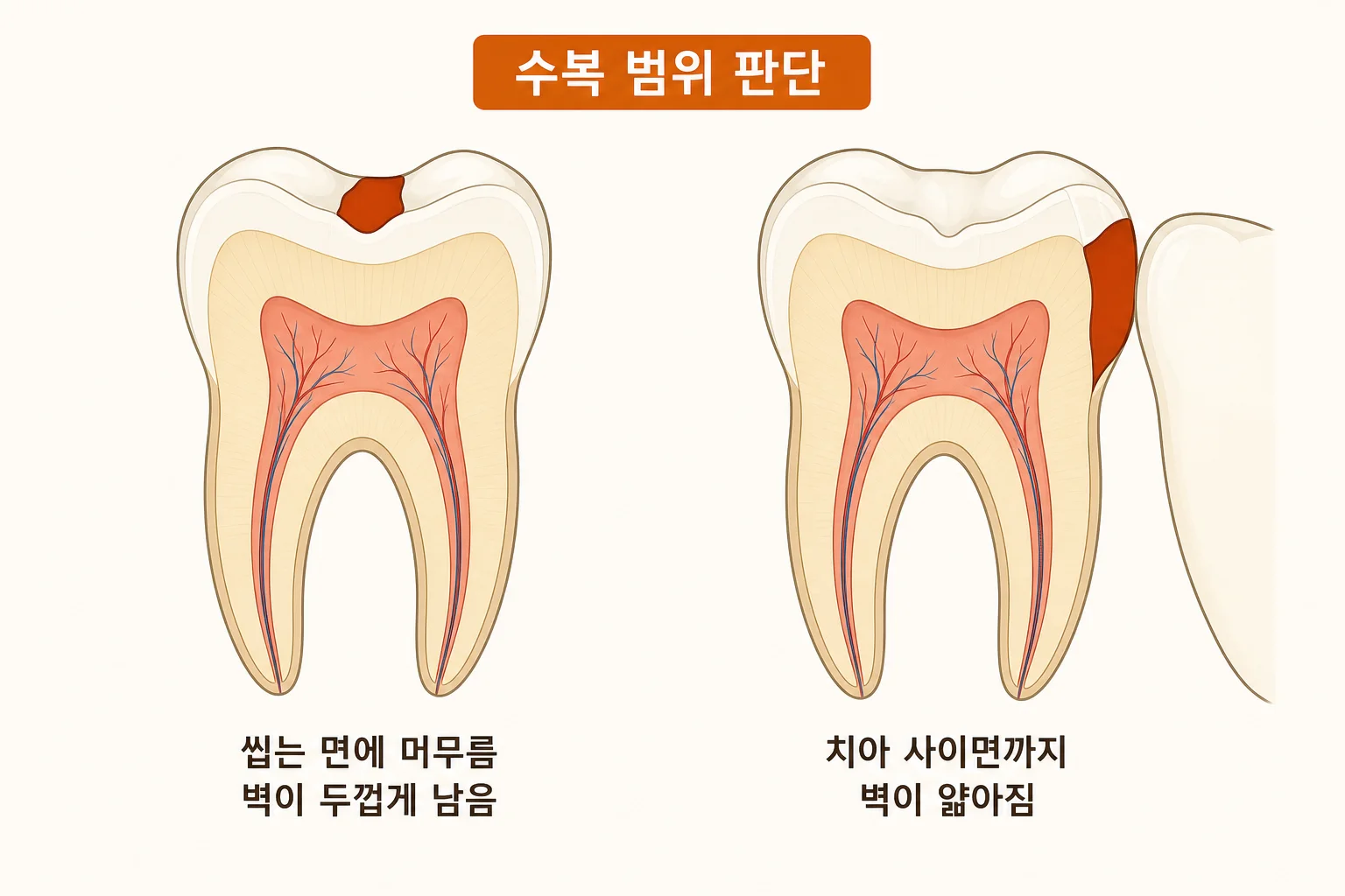 레진 인레이 선택, 충치 크기가 같아도 갈리는 이유 | 파주 서울이고운치과 내용을 설명하는 치과 진료 이미지