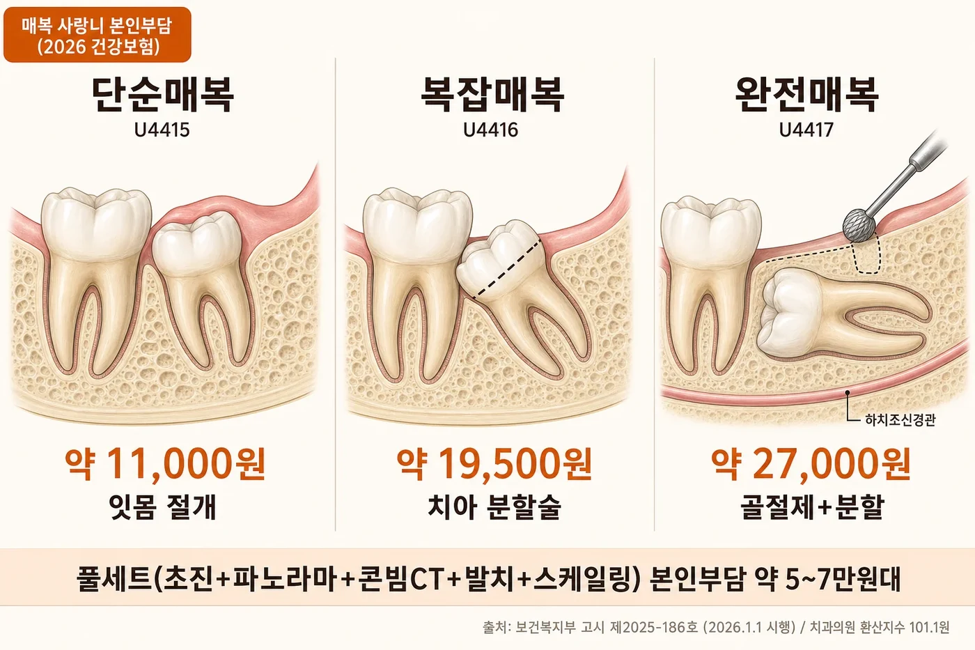 매복 사랑니 3단계 본인부담 비교 인포그래픽. 단순매복 약 11,000원, 복잡매복 약 19,500원, 완전매복 약 27,000원, 풀세트 약 5~7만원대
