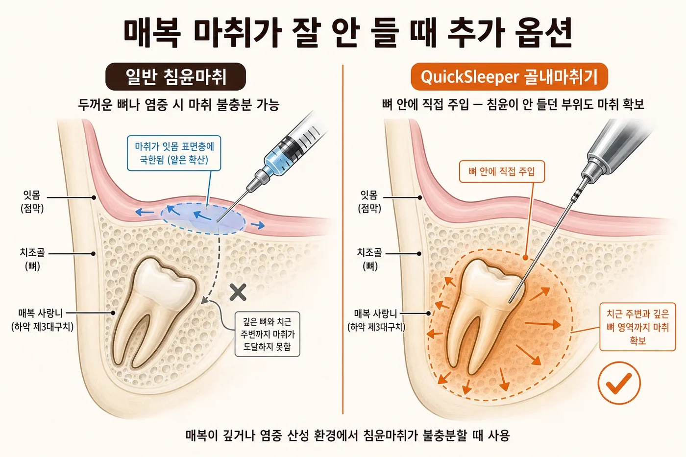 일반 침윤마취와 퀵슬리퍼 골내마취기의 마취 도달 범위를 비교한 도식