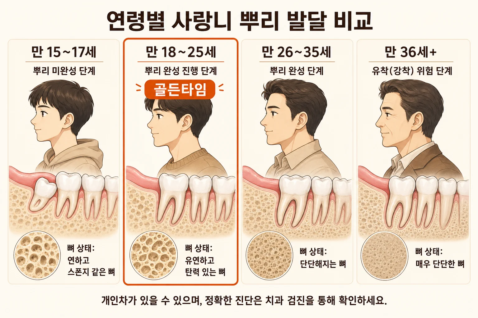연령대별 사랑니 치근 완성도와 골유착 진행 비교 인포그래픽, 10대 후반·20대·30대·40대 변화 시각화