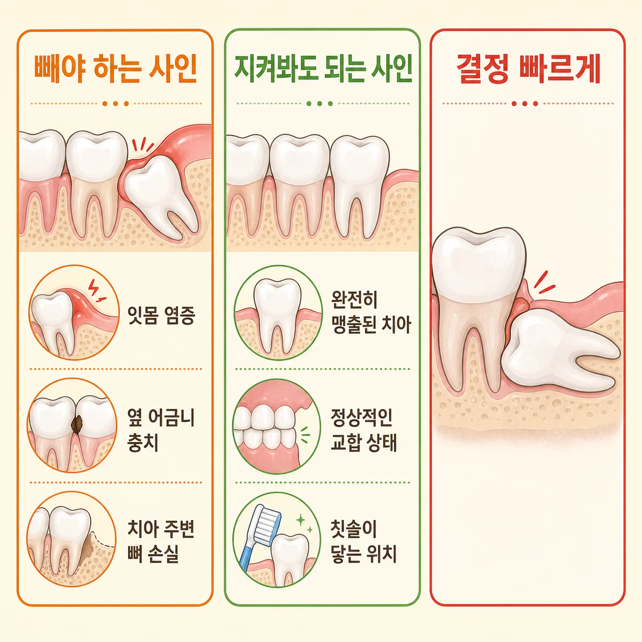사랑니 분기 표 인포그래픽, 빼야 하는 사인·지켜봐도 되는 사인·결정 빠르게 사인 시각화